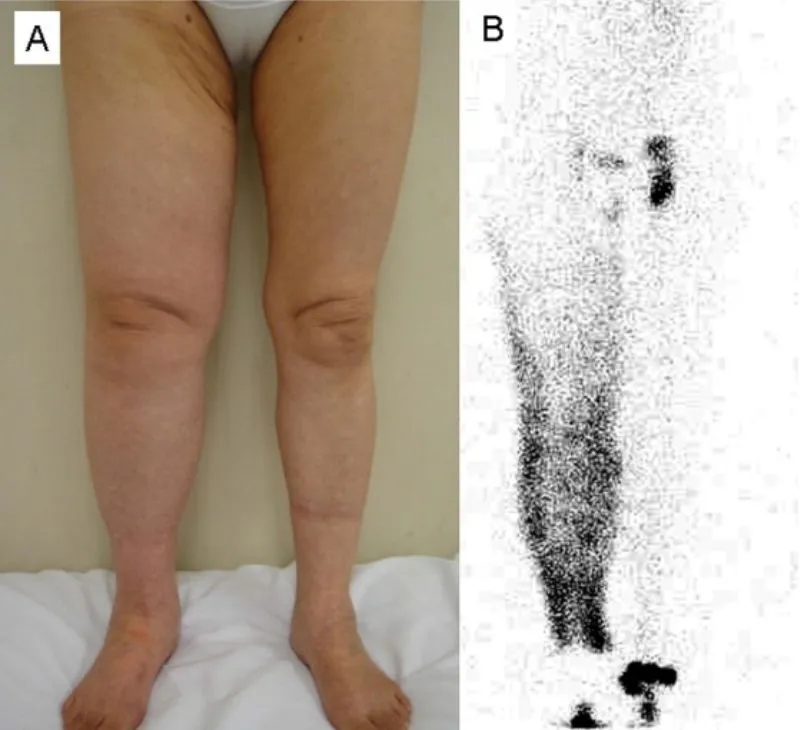 Left: visible lower-leg swelling. Right: a lymphoscintigraphy scan showing where fluid has collected in the limb